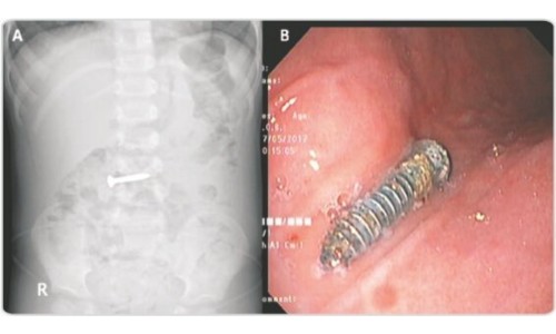 Advanced Foreign Body Removal